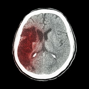 Time is important in Stroke