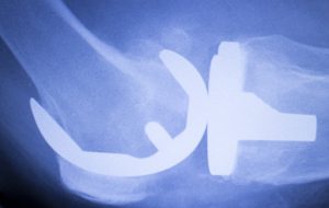 Preparing for Joint Replacement Surgery